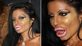 Celebrities With Horrible Plastic Surgery