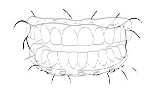 Hybridge Dental Implant Full Mouth Restoration