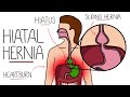 Hiatal Hernia Explained (Hiatus Hernia)