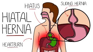 Hiatal Hernia Explained (Hiatus Hernia)