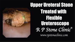 Upper Ureteral Stone treated with Flexible Ureteroscope.