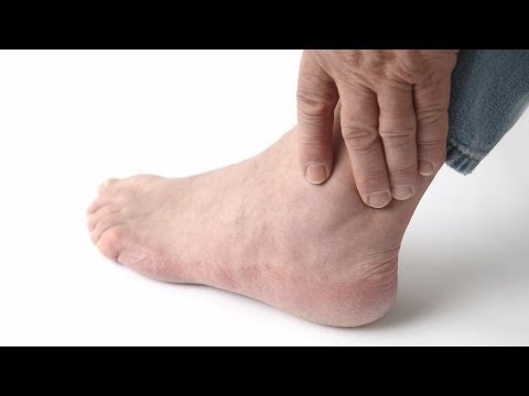 How to Recognize Gout Symptoms | Foot Care How to Recognize Gout Symptoms | Foot Care