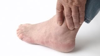 How to Recognize Gout Symptoms | Foot Care