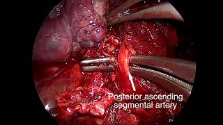 Asvide: Right upper lobectomy in case of incomplete fissure between the upper lobe and lower lobe