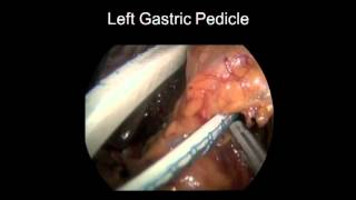 SAGES Top 21 Videos: Laparoscopic Gastric Resection