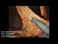 robotic right hemicolectomy complete mesocolic excision supraileal approach