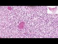 osteomyelitis histopathology