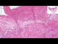 osteomyelitis histopathology