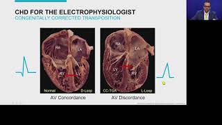 ECGs in Patients With Adult Congenital Heart Disease - Part II