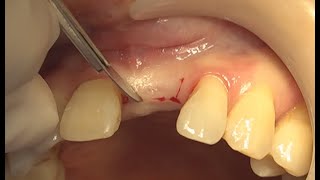 Minimally invasive surgery with Narrow implant