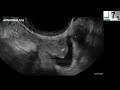 ultrasound for uterosacral ligaments normal and abnormal with endometriosis