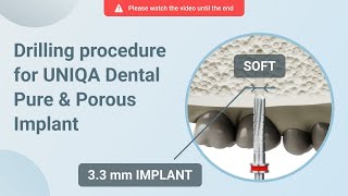 Drilling procedure for UNIQA Dental Pure \u0026 Porous Implant UH8 UV11 [ 3.3 mm | D4 bone density ]