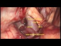 ACOM-A- ANTERIOR COMMUNICATING ARTERY ANEURYSM-microsurgery-dr suresh dugani/HUBLI/KARNATAK/INDIA