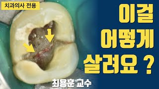 파절치아 접착 치료, 플라즈마 1회 재신경 치료 #판교최용훈치과