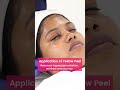 yellow peel treatment step by step peel off treatment for pigmentation vcare clinics