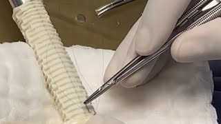 Handmade Valved Woven Dacron Conduits as an Alternative for Repair of Congenital Heart Defects