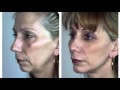 Chin Implants in Seattle WA | Dr William Portuese