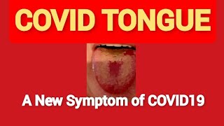 What is a COVID TONGUE?  COVID Tongue can be a new symptom of Coronavirus Infection.