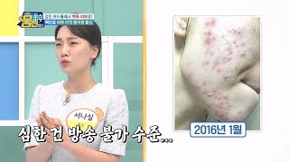 얼굴에 가득 찬 화농성 여드름(ㅜㅜ) 색소침착까지 오며 고생한 몸신 | 나는 몸신이다 403 회