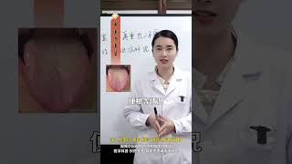 这种黄腻苔，湿热再重也不要吃龙胆泻肝丸  #健康生活很简单 #健康热点  #暖冬健康指南