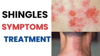 Herpes Zoster (Shingles) Symptoms, Treatment, Vaccine, Contagious, Rash, Pain Relief, Medication