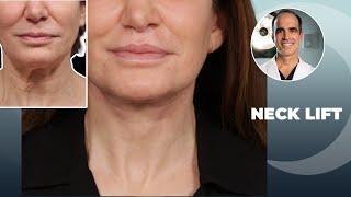 How to Fix a Sagging Neck with These 2 Simple Steps | Los Angeles