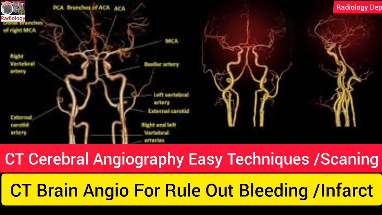 Cerebral Angiogram Anatomy
