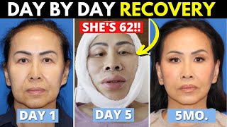 62 Year Old Undergoes Life Changing Facelift, Fat Transfer and Lip Lift!