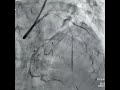 Grade lll coronary artery perforation