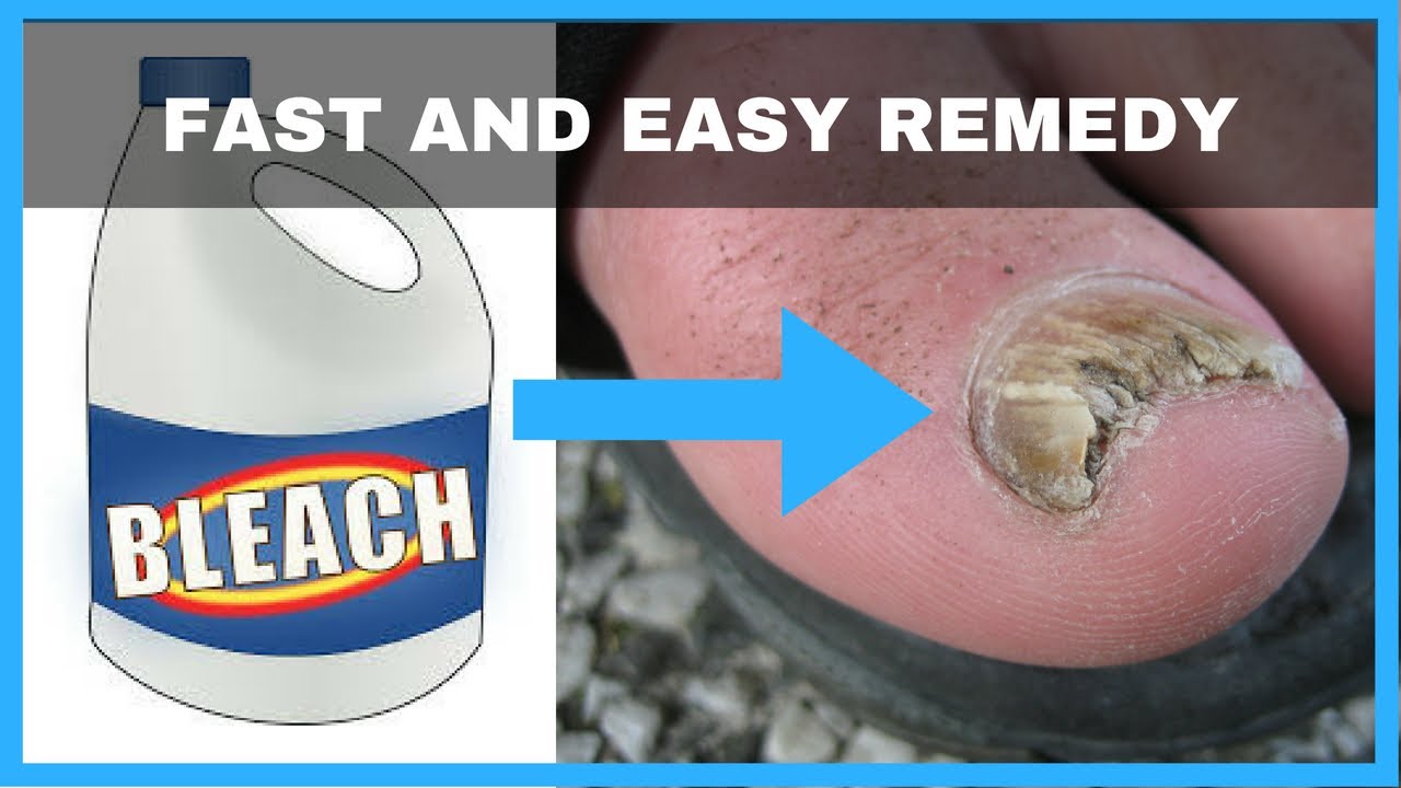 How To Get Rid Of Toenail Fungus With Bleach - Toe Fungus Journey - YouTube