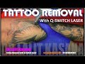 BIG TATTOO REMOVAL by DR.LALIT KASANA for appointment call- +91-8010840001