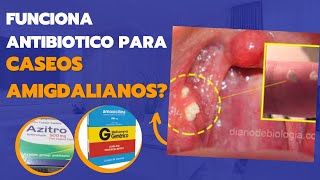 Antibiótico para caseo nas amigdalas (bolinhas fedidas na garganta)?