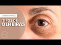 Conheça os Tipos de Olheiras