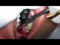 surgical extraction of a distoangular impacted third molar