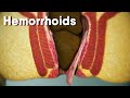 Hemorrhoids|different types of hemorrhoids| internal and external Hemorrhoids| Hemorrhoids treatment