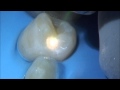 Video Case Study: Class II Procedure Using the Solea Dental Laser