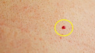Do You Have Red Spots On Your Skin? Here's What They Mean...