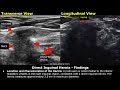 hernia ultrasound reporting direct indirect inguinal epigastric femoral hernia usg reports