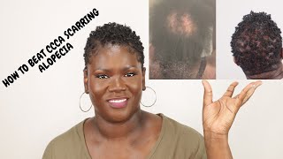 5 things that really work for CCCA or scarring alopecia