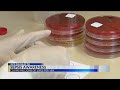 Eye on Health: Sepsis