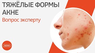 Тяжелые формы акне: вопрос эксперту