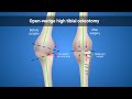 Over-corrected misalignment associated with poorer outcomes after open-wedge high tibial osteotomy