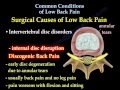 Low Back Pain,sciatica, Disc surgery- Everything You Need To Know - Dr. Nabil Ebraheim