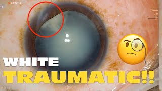 Phaco Clip #241 - Traumatic White Cataract