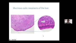 G-ECHO Surgical presentation : Cystic Lesions