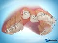 alignement orthodontique 2 canines