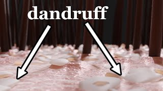 How Dandruff Forms – and Why | ANIMATION