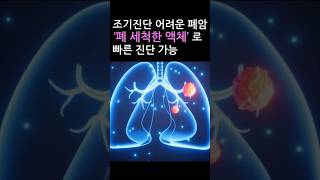 조기진단 어려운 폐암, 폐 세척한 액체로 빠른 진단 가능