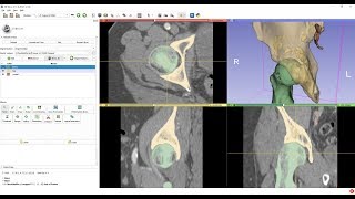 Femur segmentation using masked region growing in 3D Slicer
