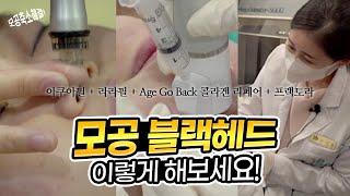 모공 블랙헤드 완전 정복, 나비존 늘어진 모공 해결해볼게요!